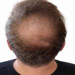 Example angle: Crown