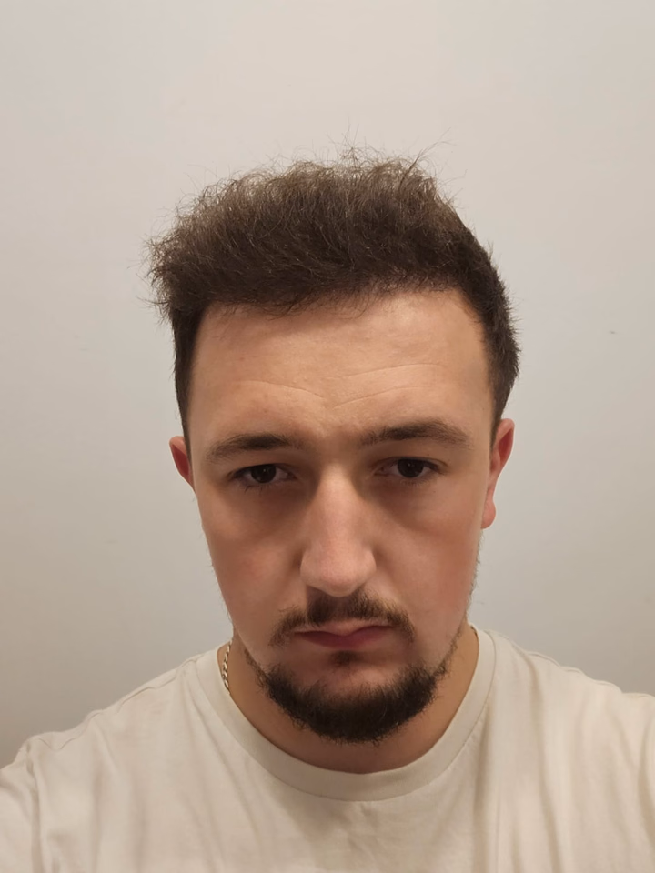 After hair transplantation, comparison 01