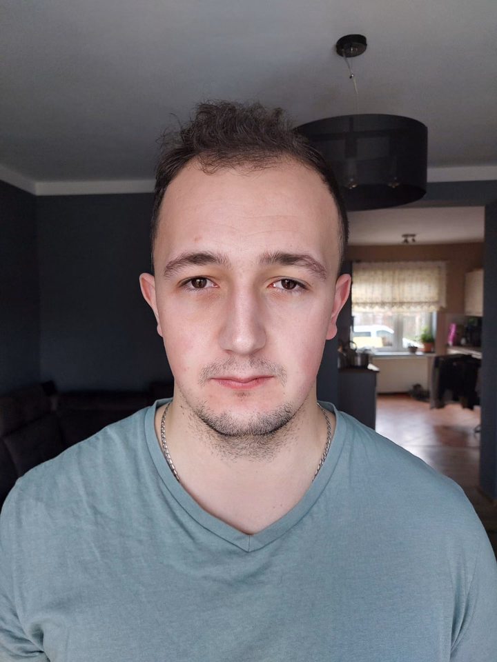 Before hair transplantation, comparison 01