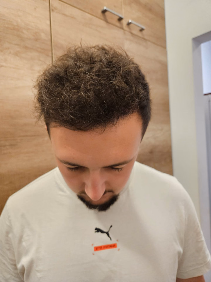 After hair transplantation, comparison 02
