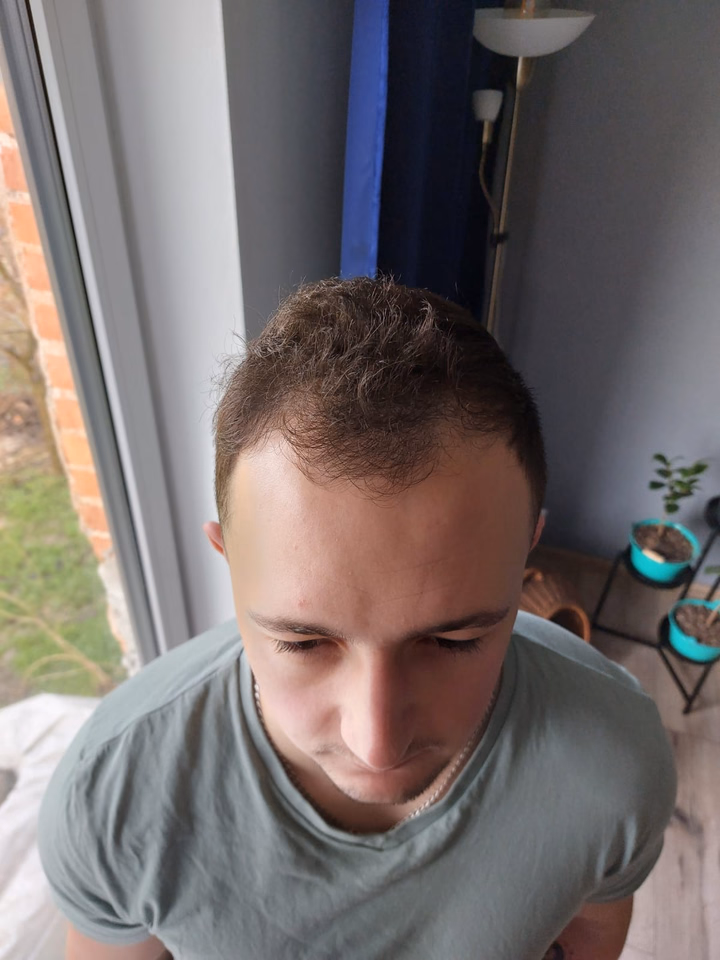 Before hair transplantation, comparison 02