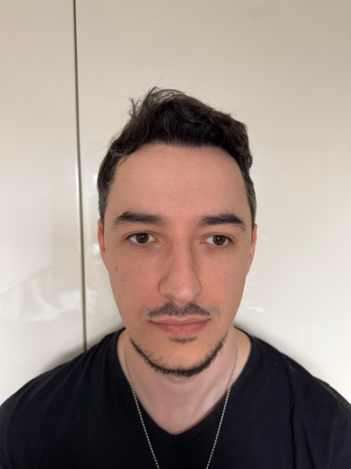 After hair transplantation, comparison 04