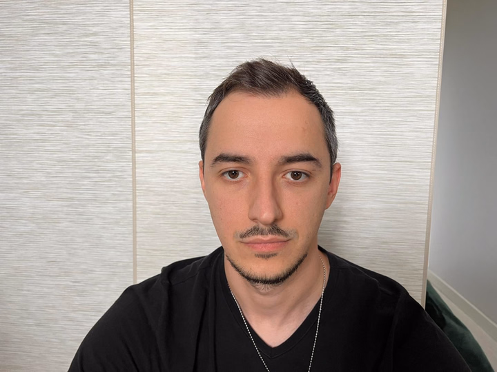 Before hair transplantation, comparison 04