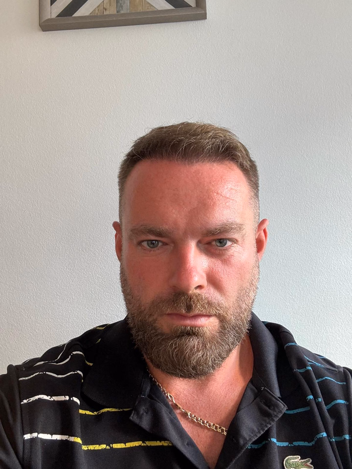 Before hair transplantation, comparison 05