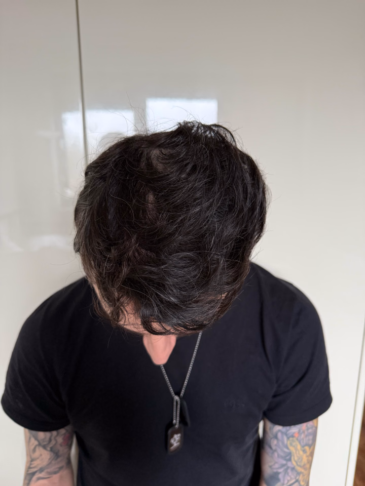 After hair transplantation, comparison 07