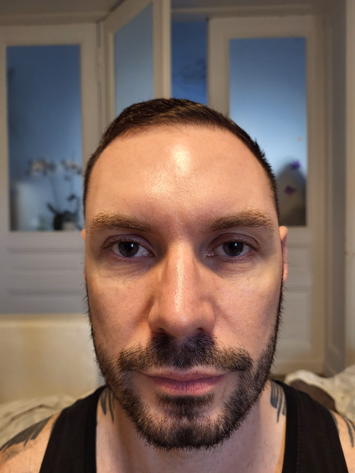 Before hair transplantation, comparison 10