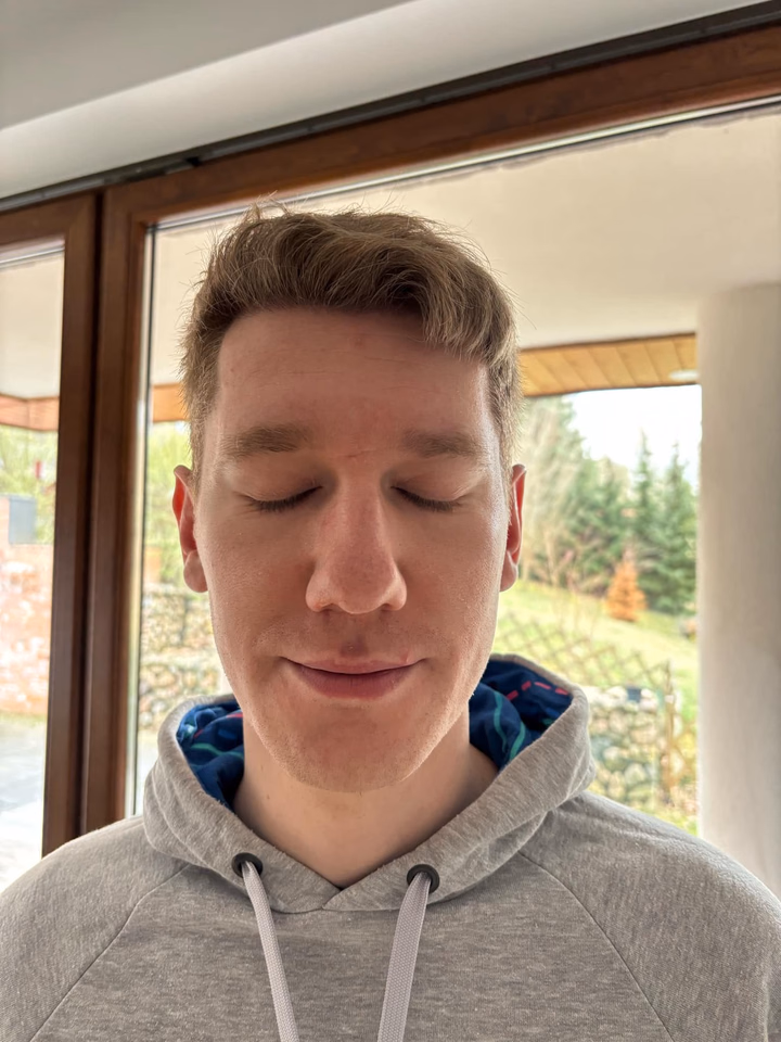 After hair transplantation, comparison 11