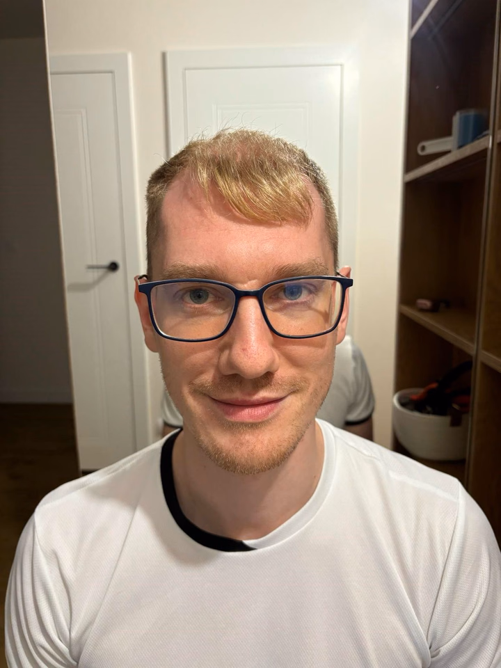 Before hair transplantation, comparison 11