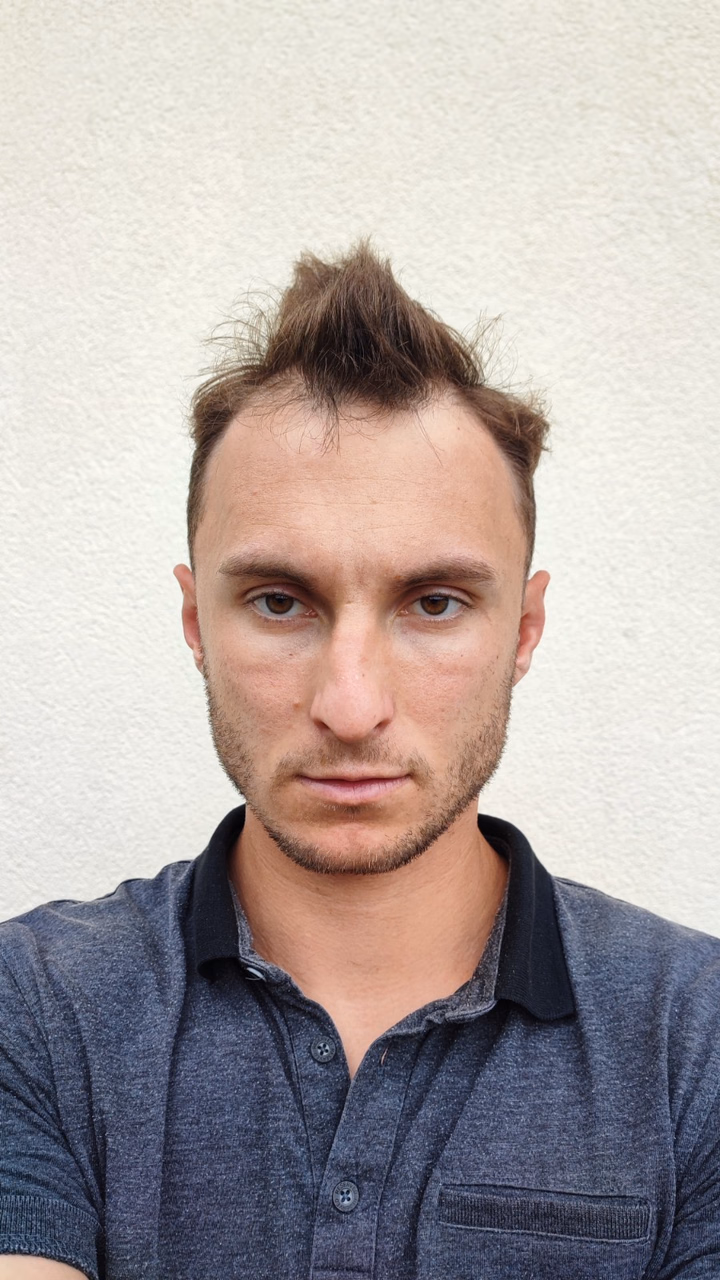 Before hair transplantation, comparison 13