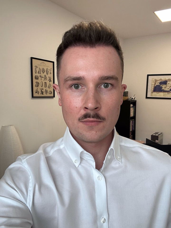 After hair transplantation, comparison 14
