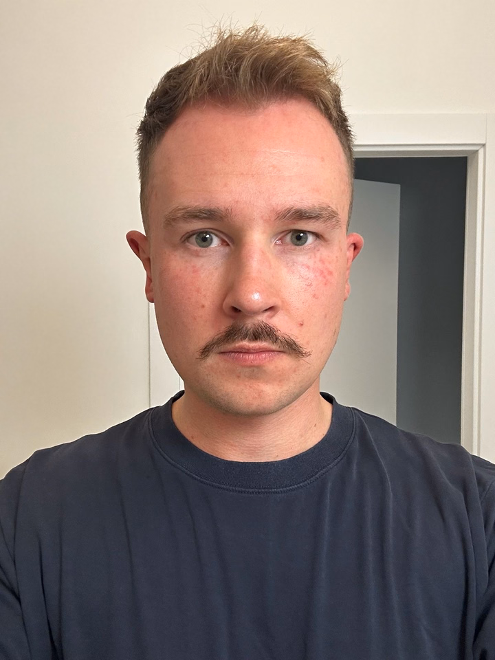 Before hair transplantation, comparison 14