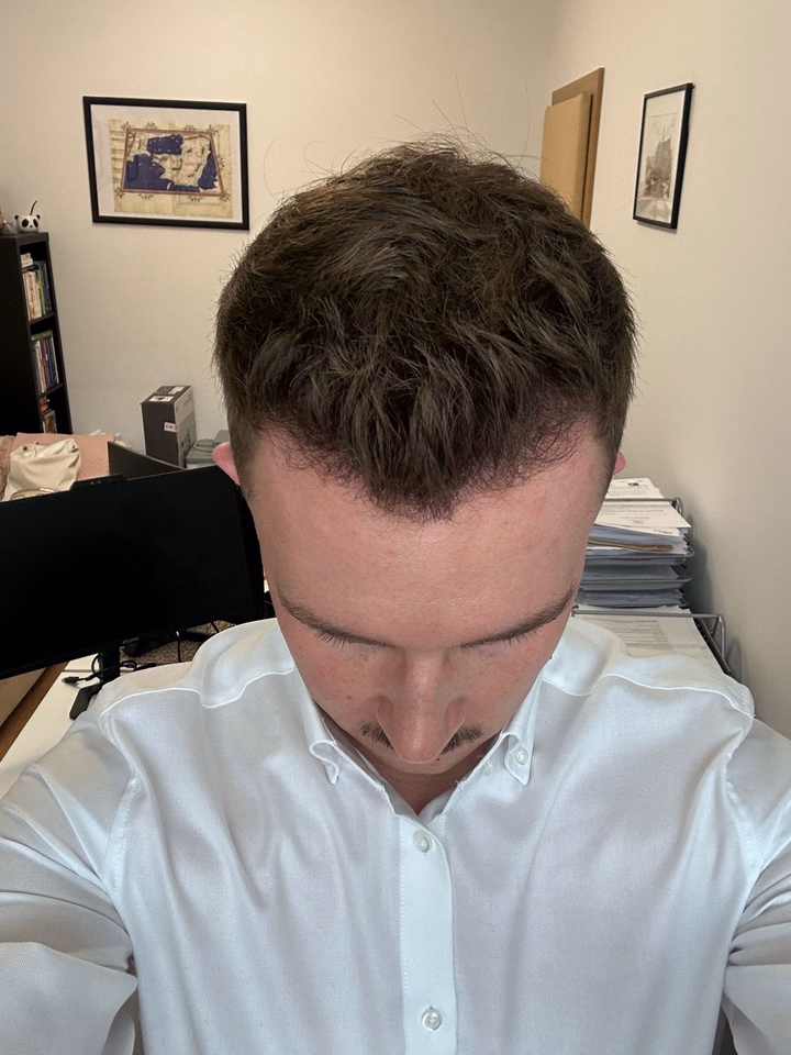 After hair transplantation, comparison 15