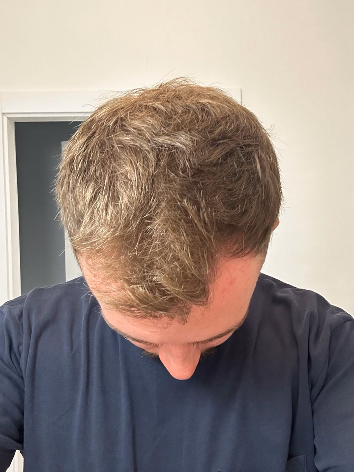 Before hair transplantation, comparison 15