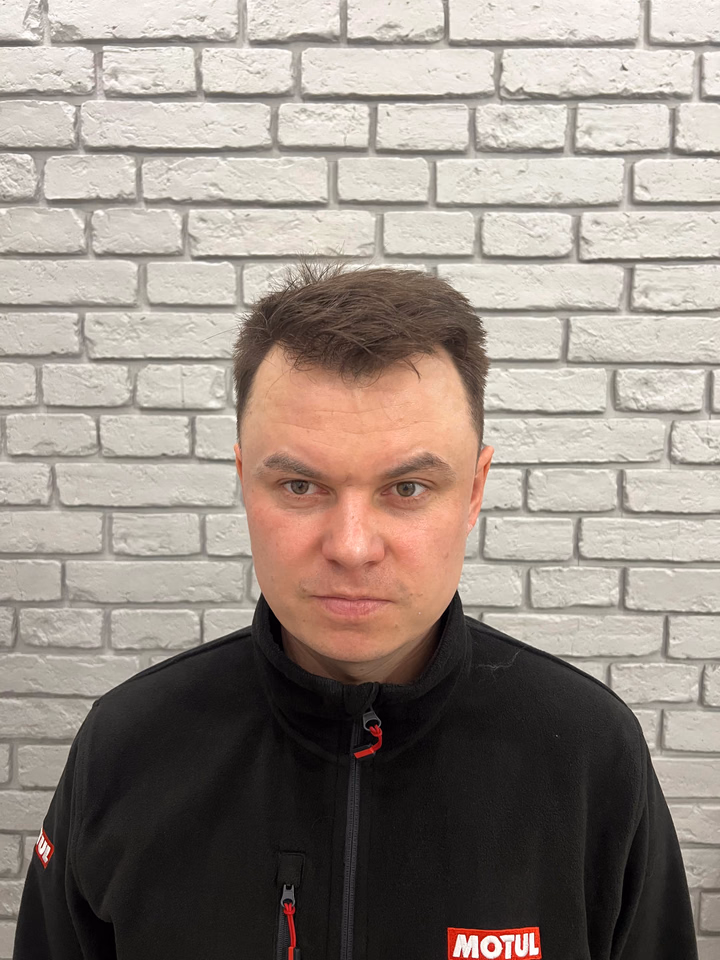 After hair transplantation, comparison 16