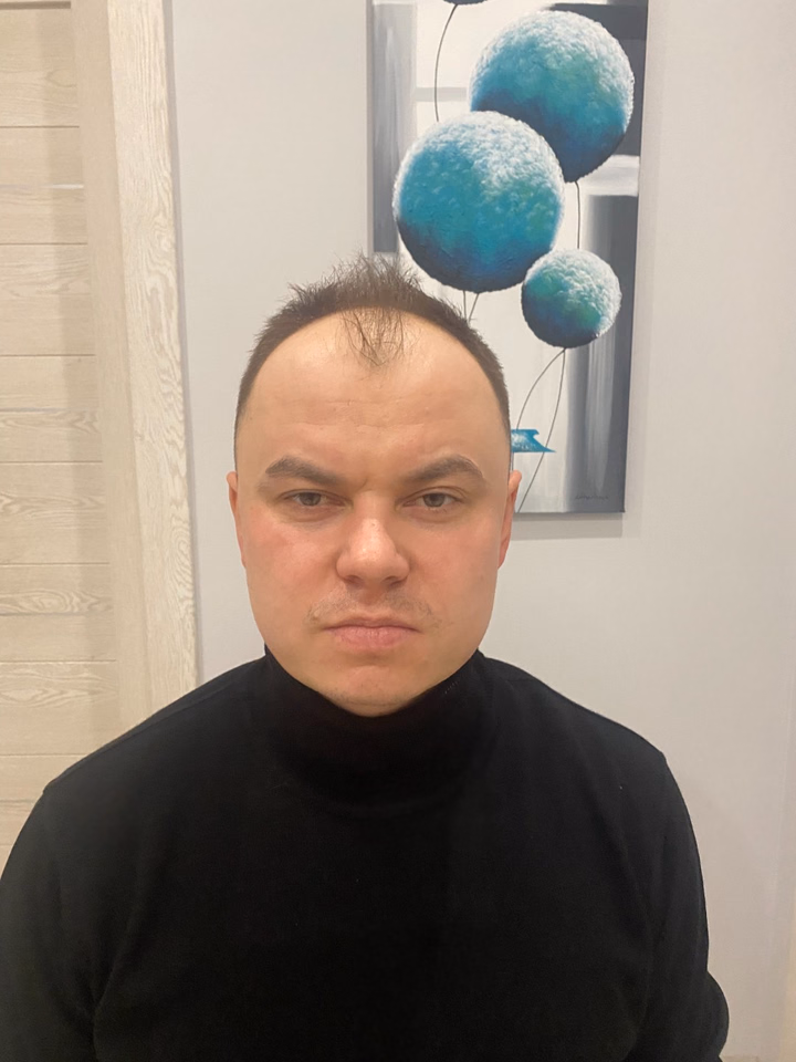 Before hair transplantation, comparison 16