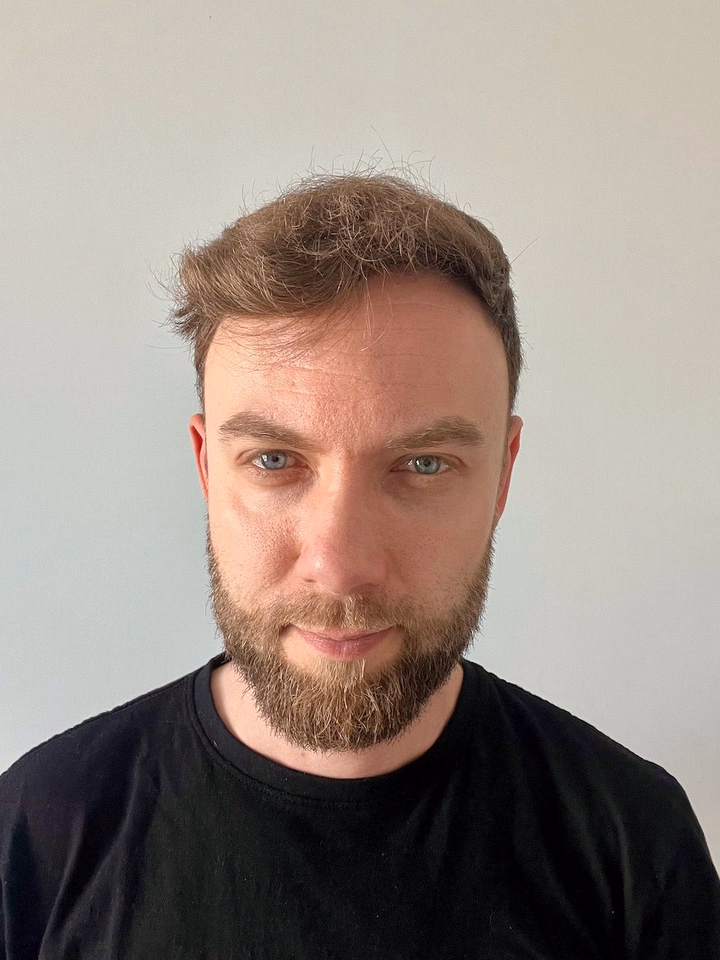 After hair transplantation, comparison 17