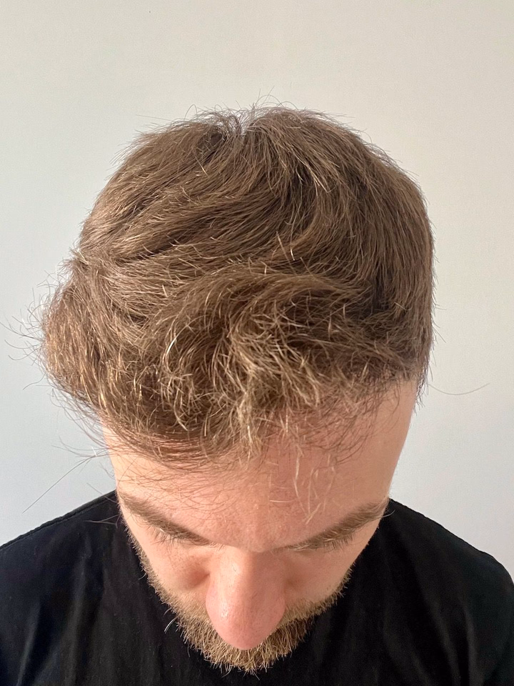 After hair transplantation, comparison 18