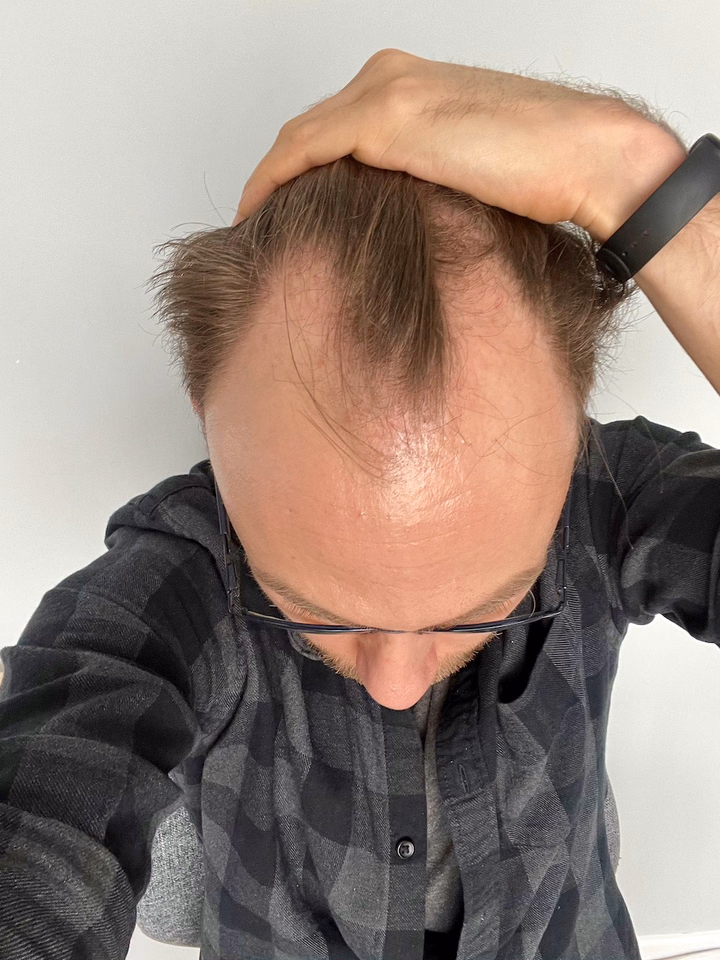 Before hair transplantation, comparison 18