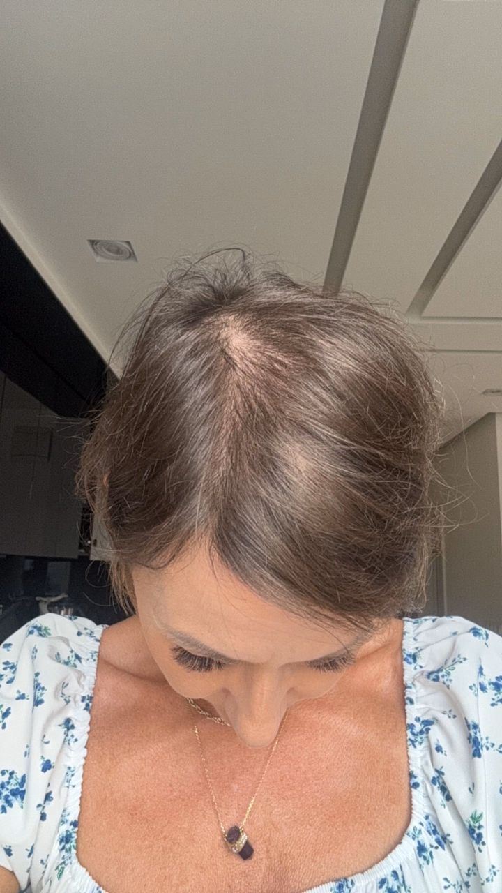 After hair transplantation, comparison 19
