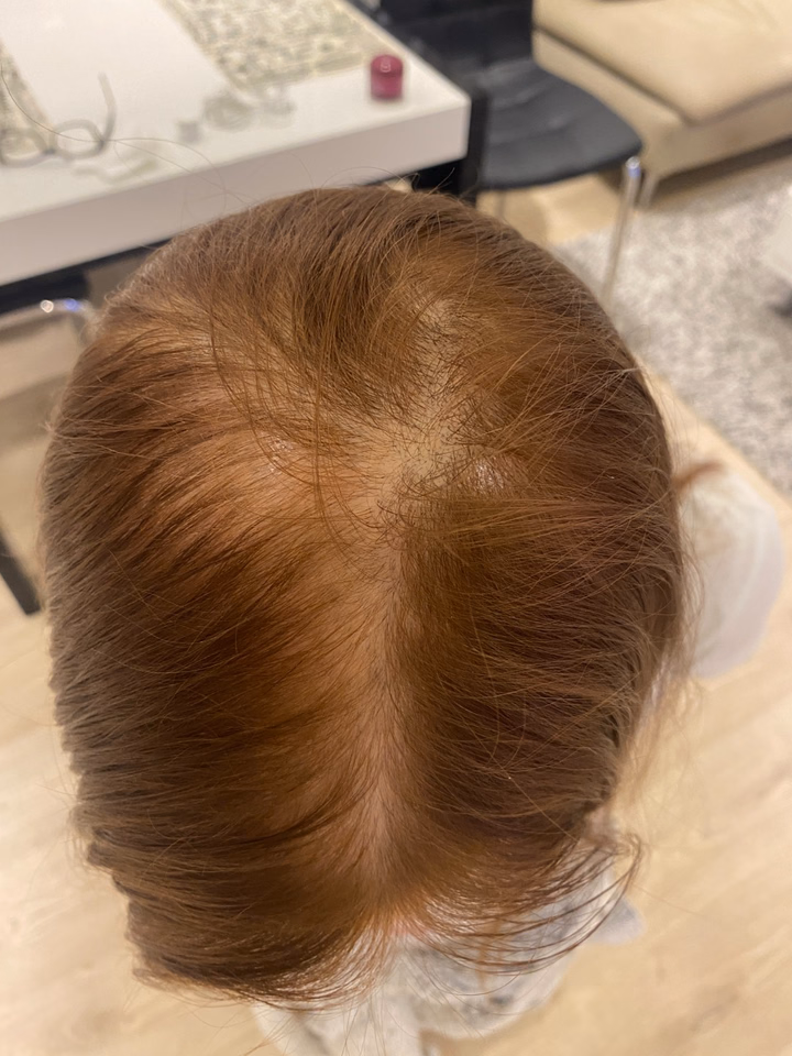Before hair transplantation, comparison 19