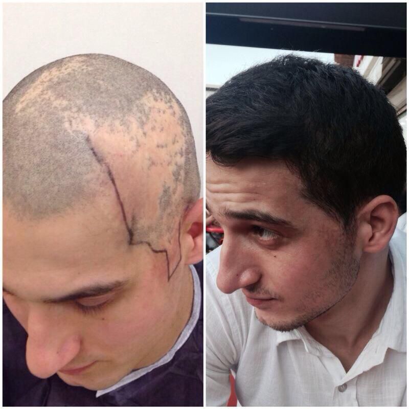 Zdjęcia przed i po, pokazujące skórę głowy z blizną oraz większe pokrycie włosami